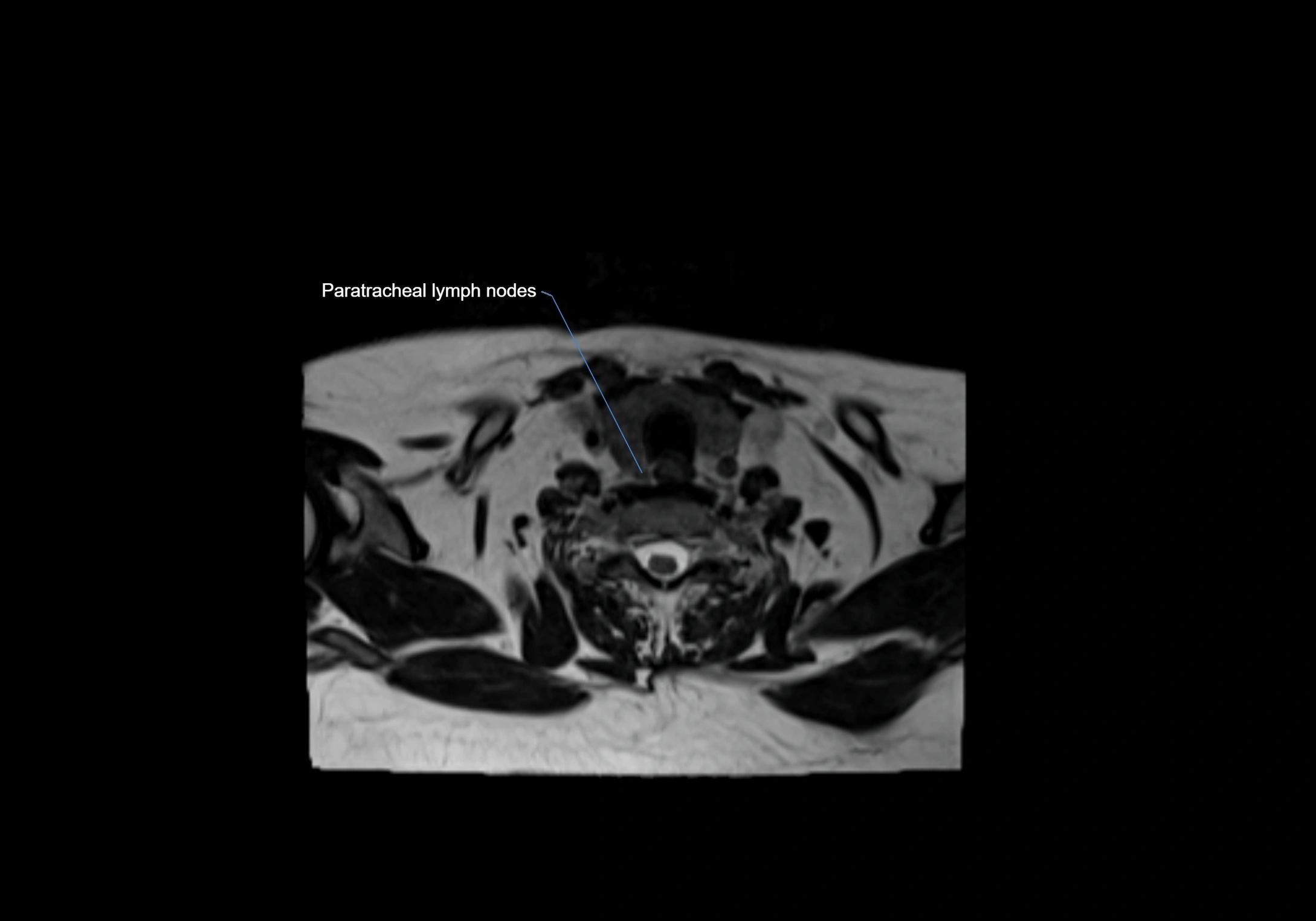 Neck axial  lymph node cross sectional MRI anatomy 3T MRI  image-img-00001-00082.webp